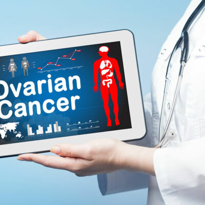 Ovarian Cancer – Stages and Risk Factors