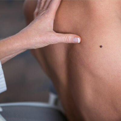 Causes and Risk Factors of Melanoma