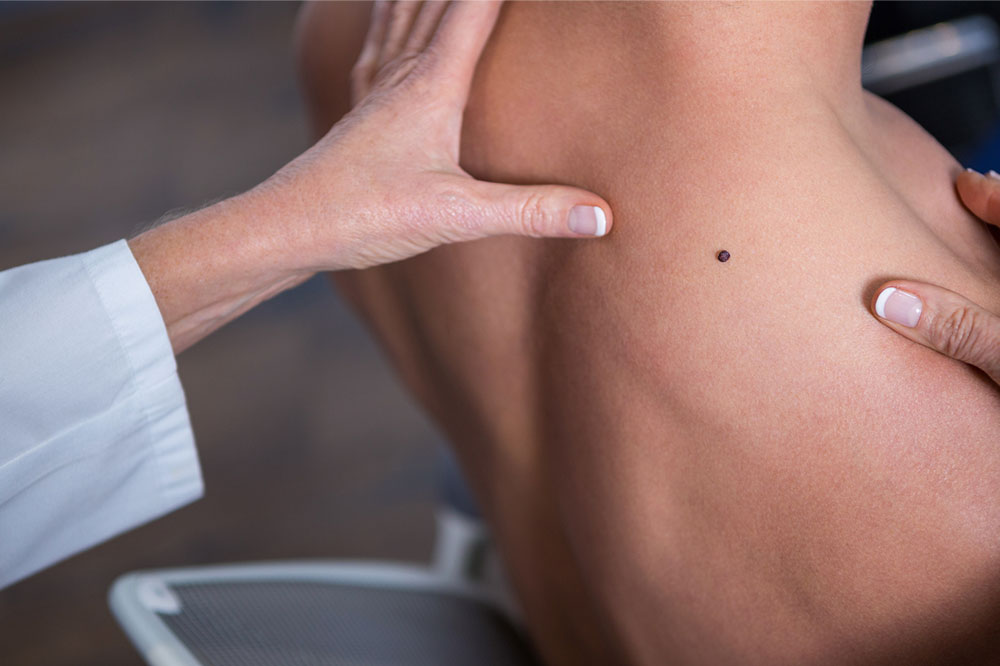 Causes and Risk Factors of Melanoma
