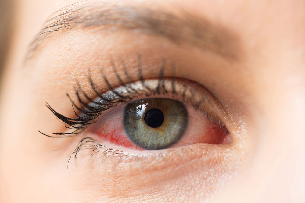 Dry Eye Diagnosis and Treatment