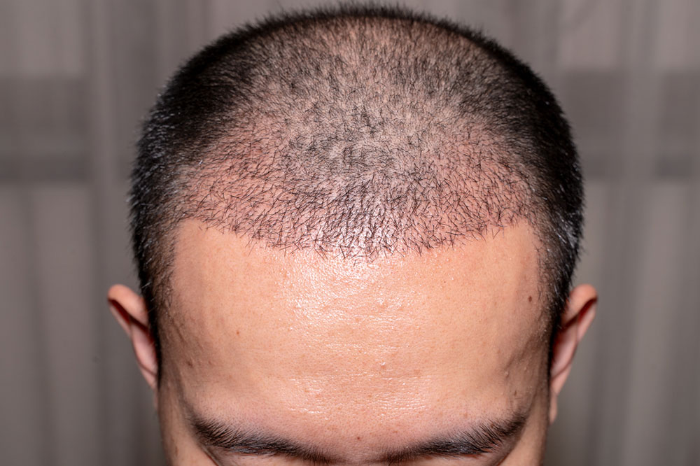 Effective Tips to Regrow Hair Naturally
