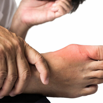 Lifestyle Tips to Manage Gout