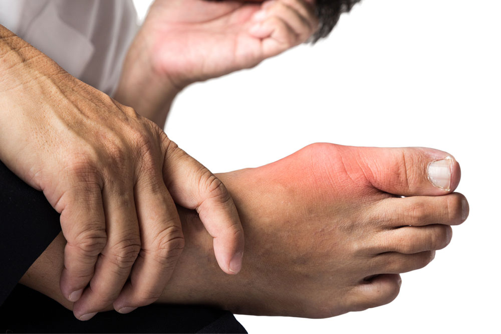 Lifestyle Tips to Manage Gout
