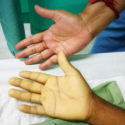 6 Risk Factors for Anemia