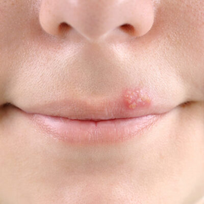 7 Preventive Measures for Cold Sores