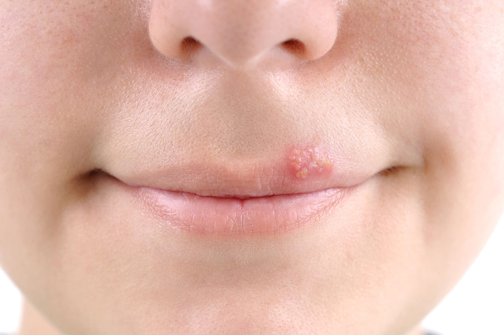 7 Preventive Measures for Cold Sores